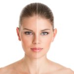 IPL Photofacial – Skin Rejuvenation Advanced